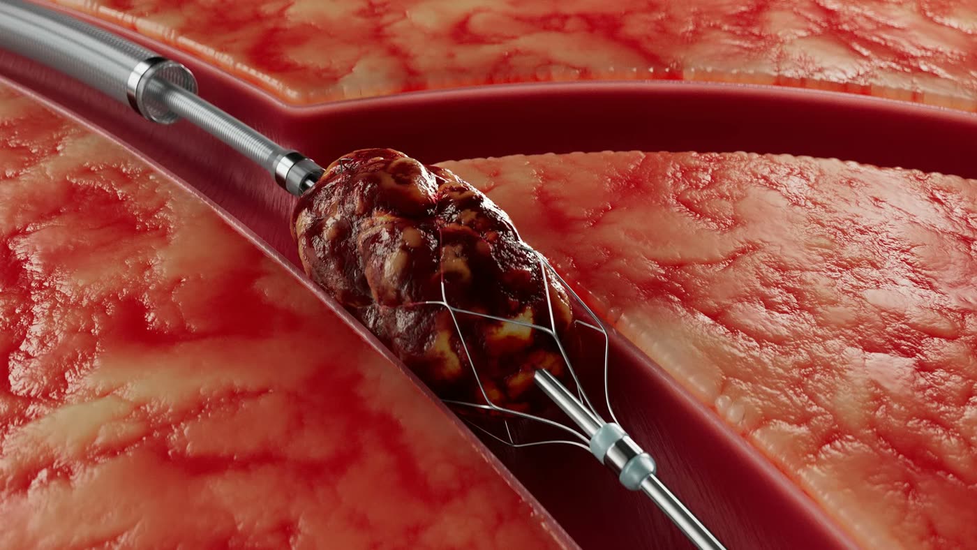 Thrombectomy in vessel