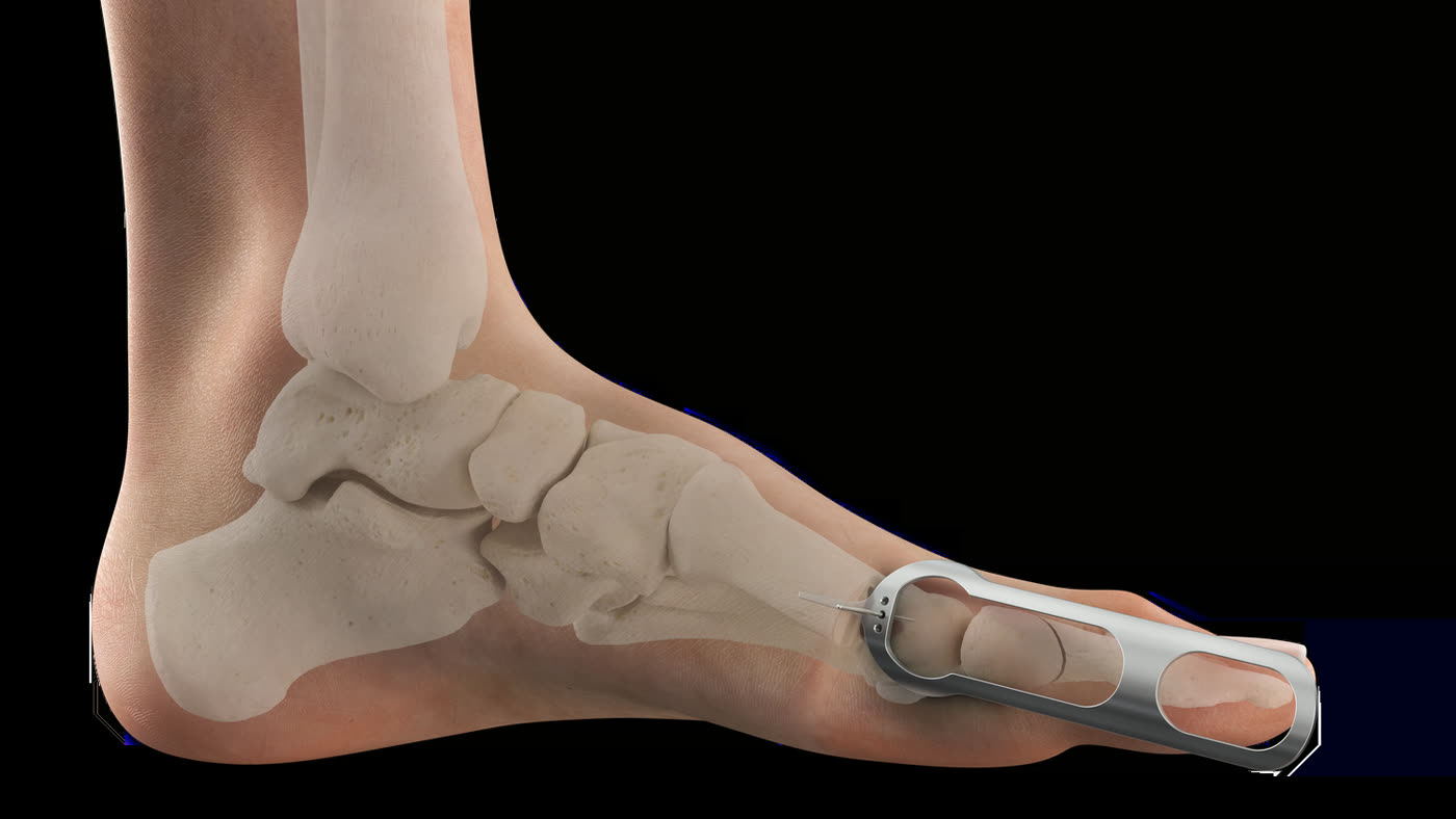 Minimally invasive approach