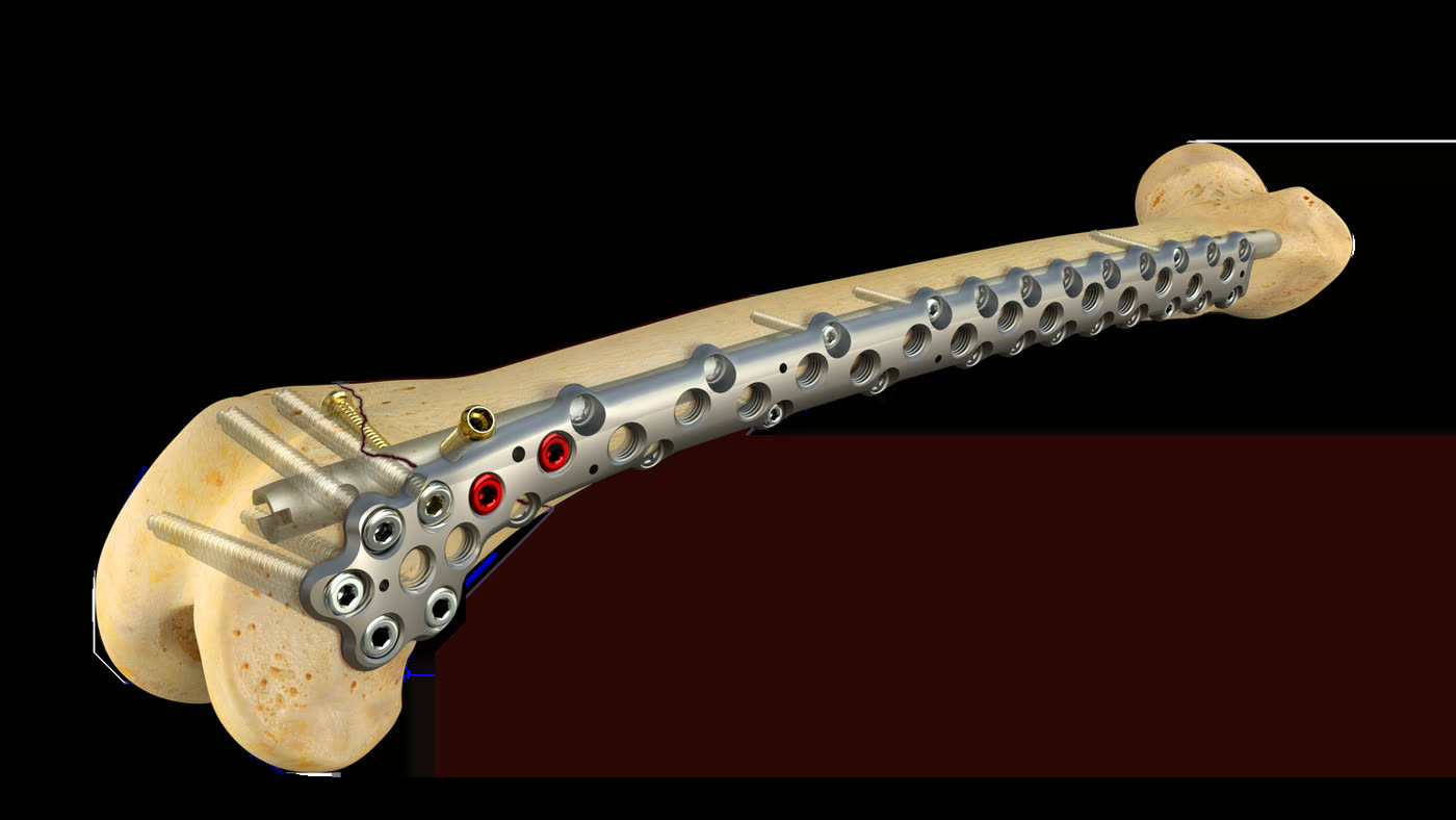 Plate and nail fixation